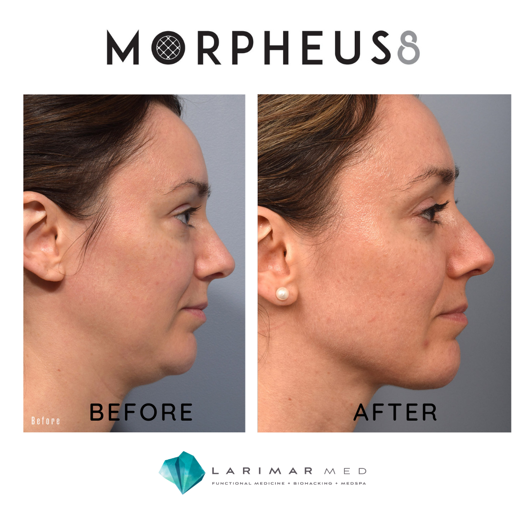 Morpheus8 For Neck And Jawline – MIDF