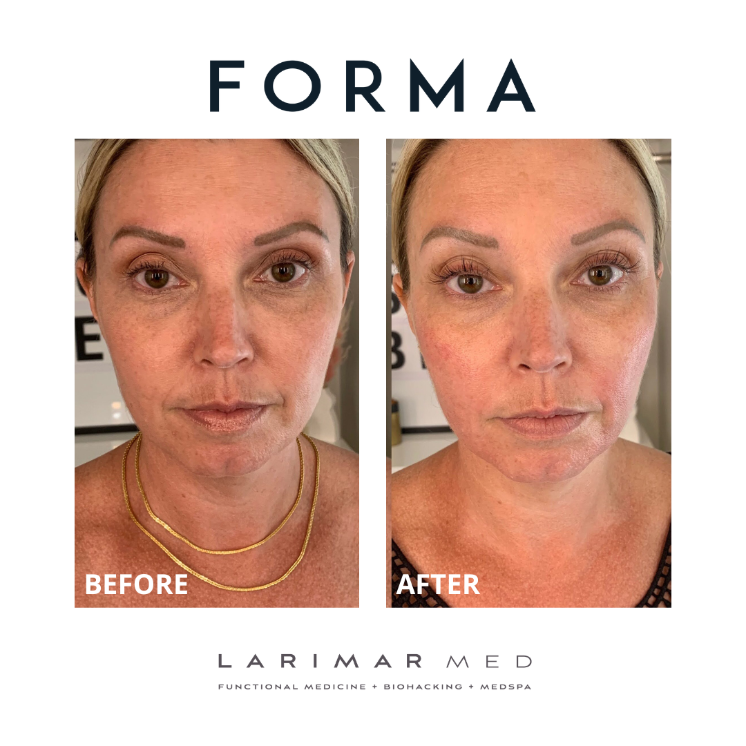 the-forma-facial-in-st-charles-illinois-larimar-med
