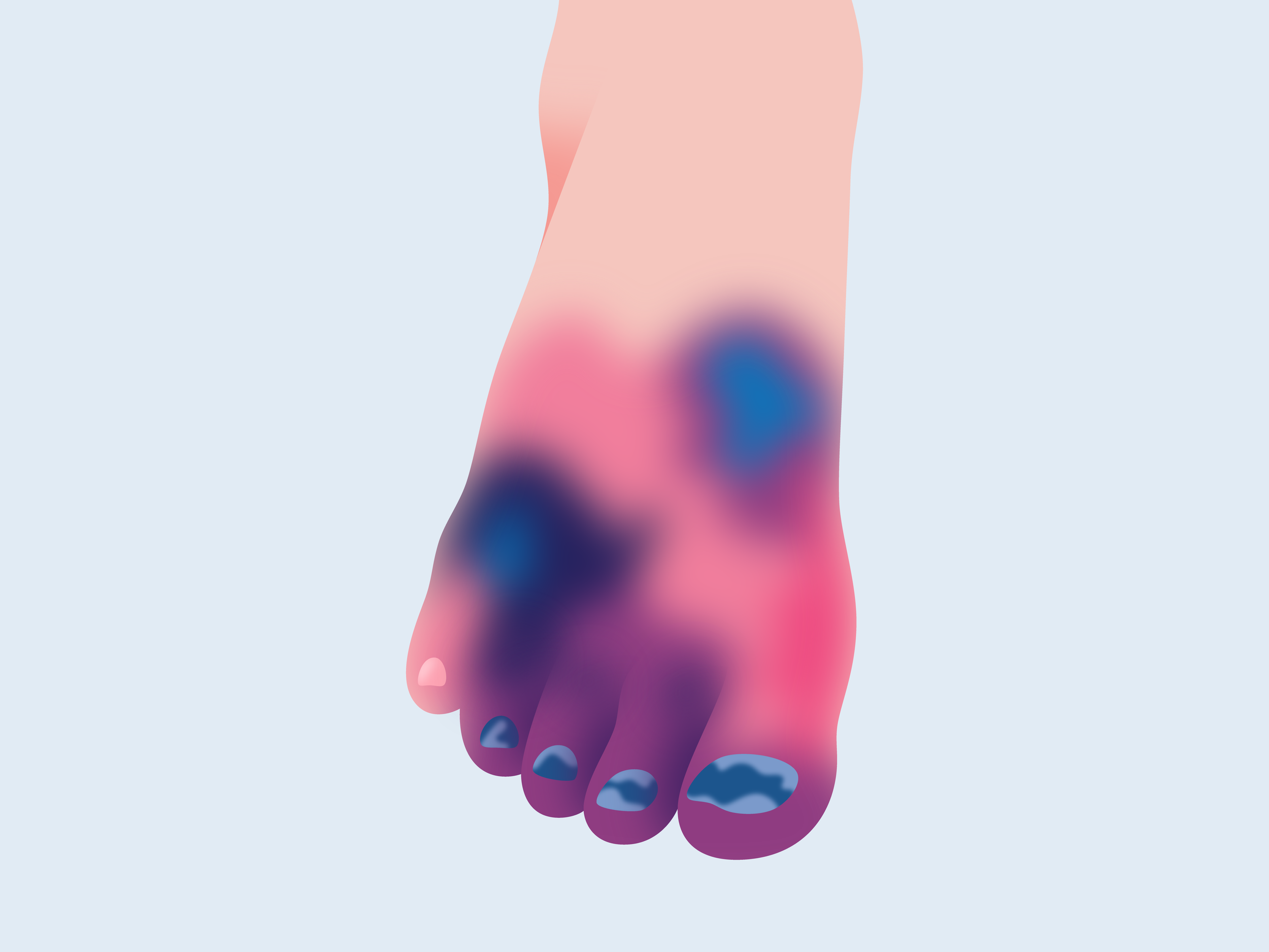 Gangrene Wound Care — Vascular Health Clinics Michigan’s 1 Vascular Surgery Program
