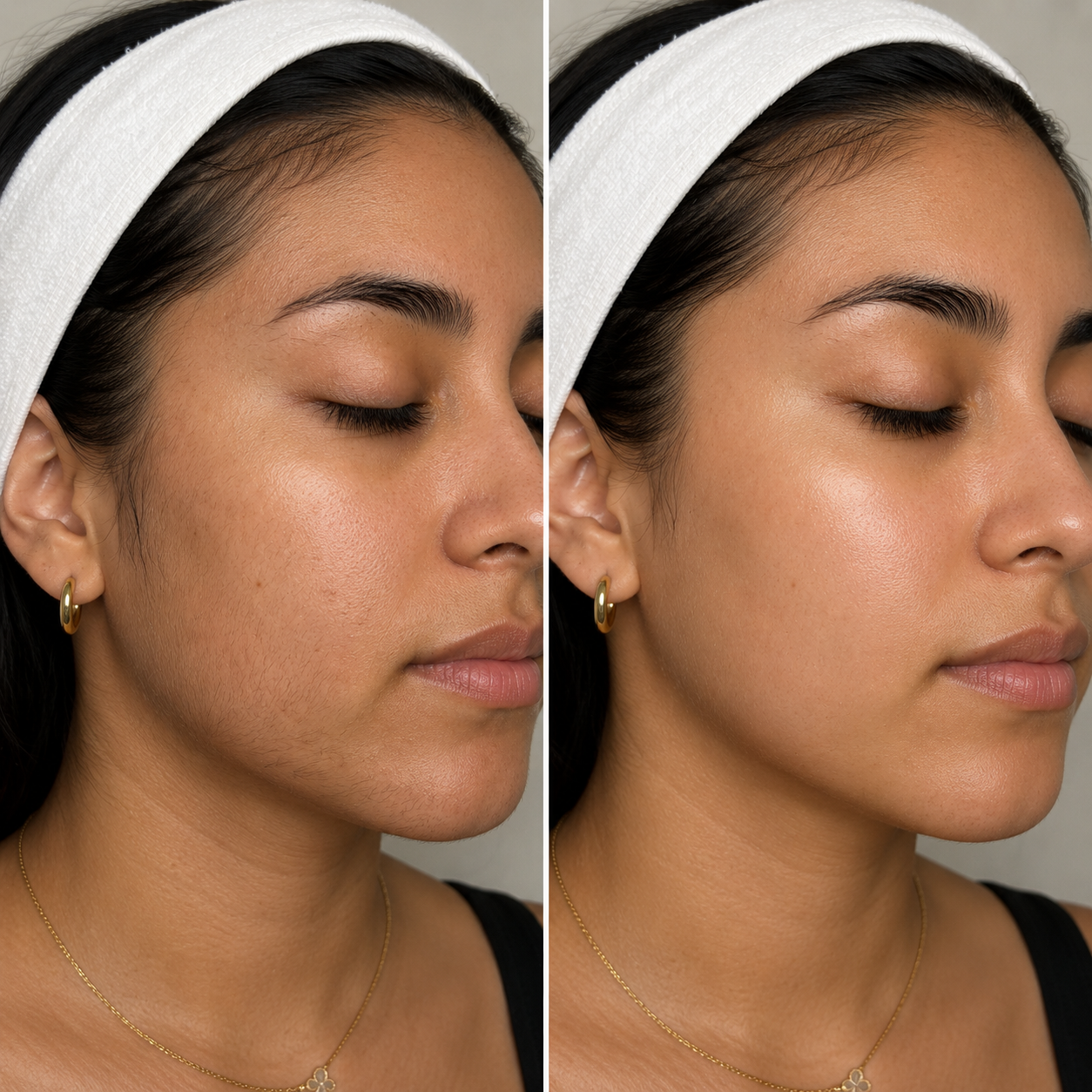 dermplane facial before and after results fitzpatrick 4.png