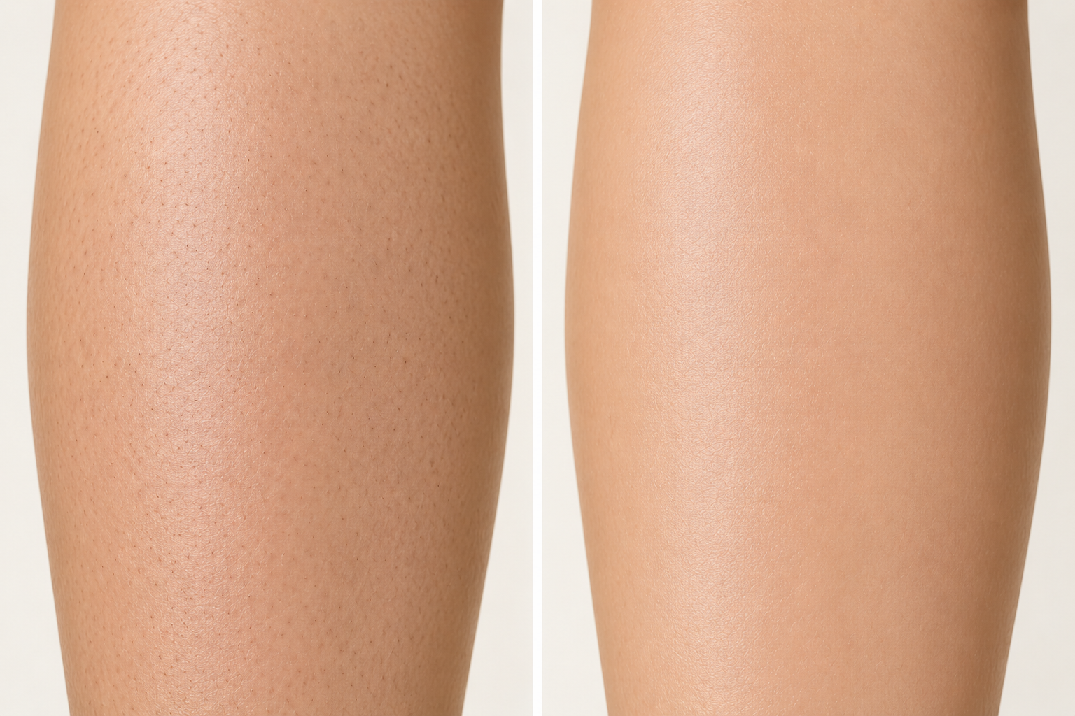 before and after laser hair removal leg hair.png