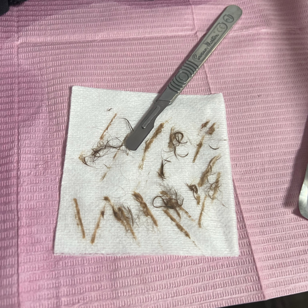 Dermaplane Vellus Hair Removal