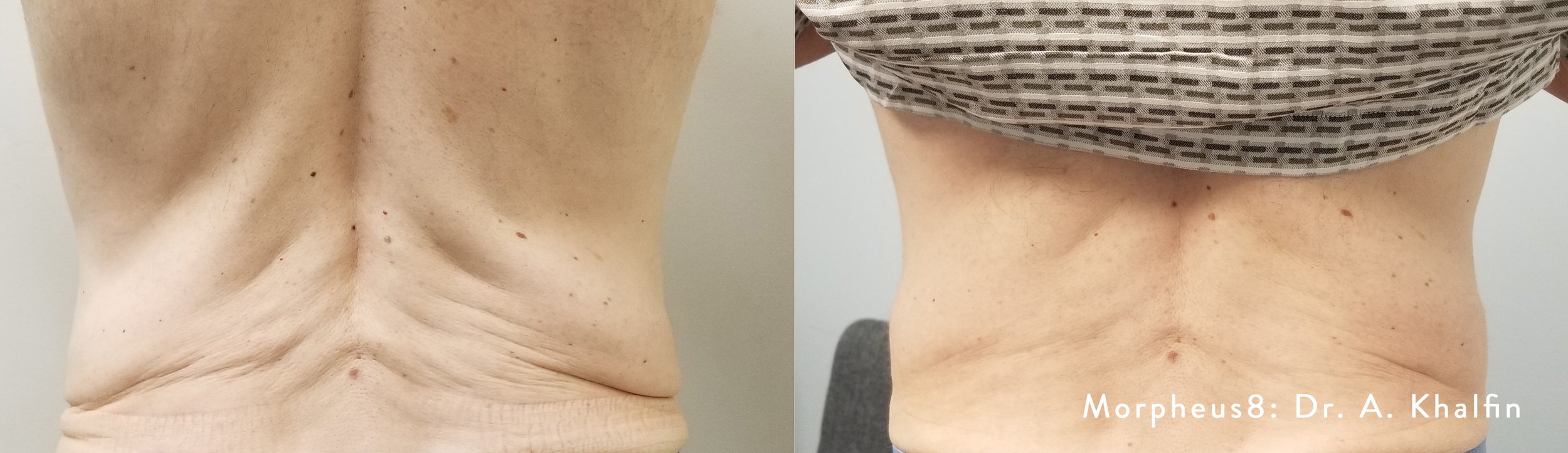 Morpheus8 Body results lower back before and after