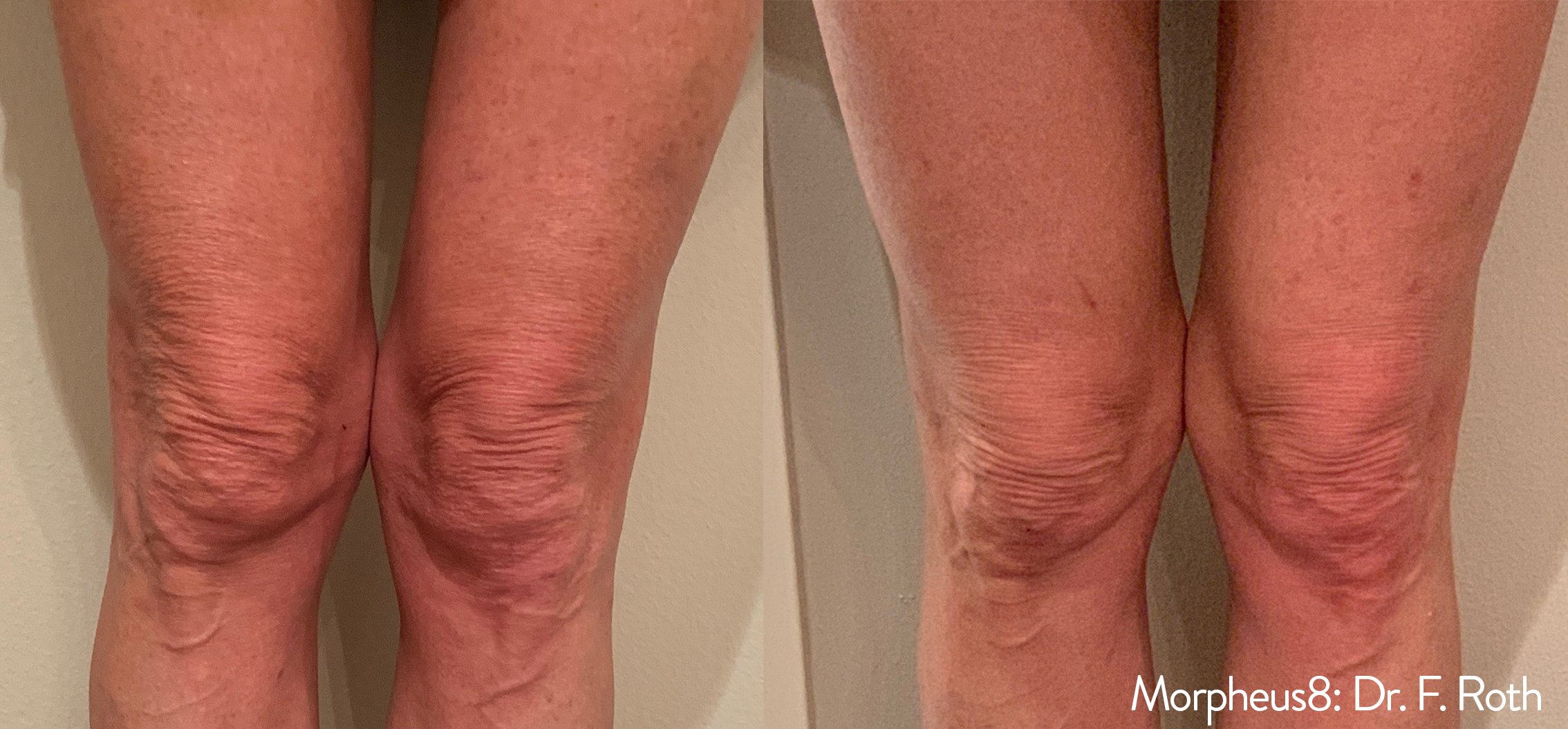 Morpheus8 Body treatment knees before and after