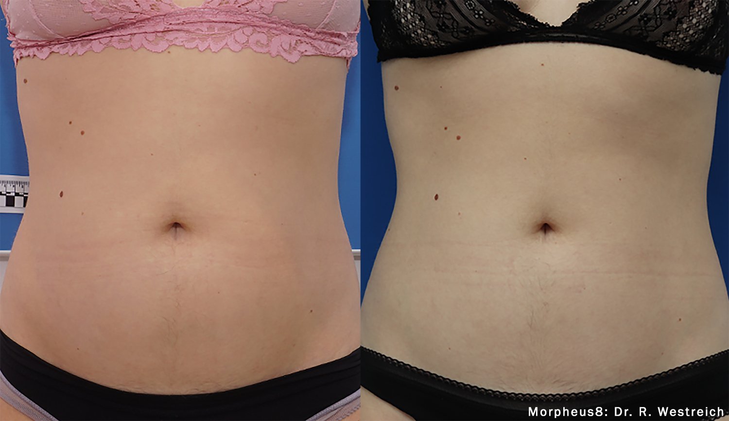 Morpheus8 Body before and after bikini tummy area