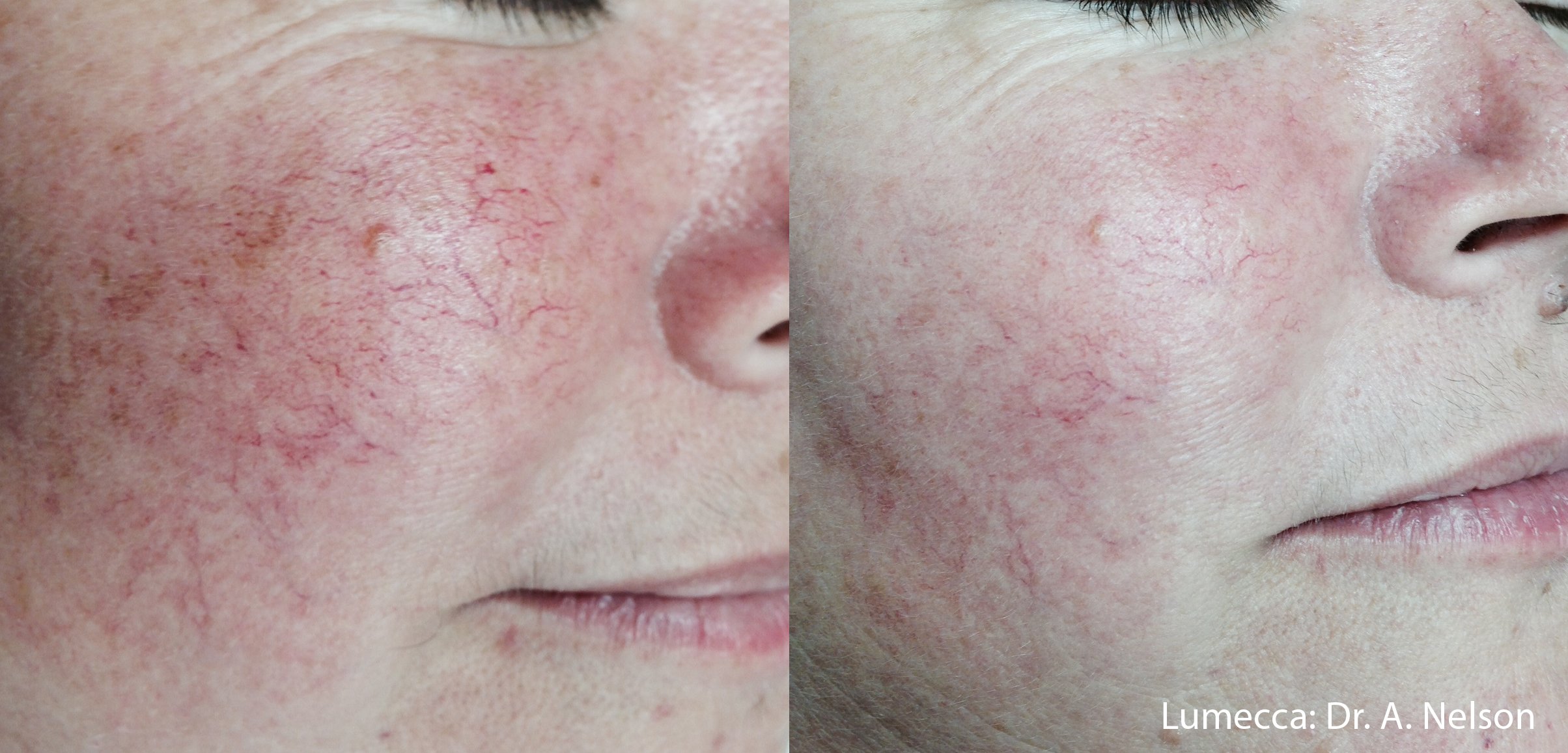 Lumecca IPL Photofacial treatment before and after redness on cheeks
