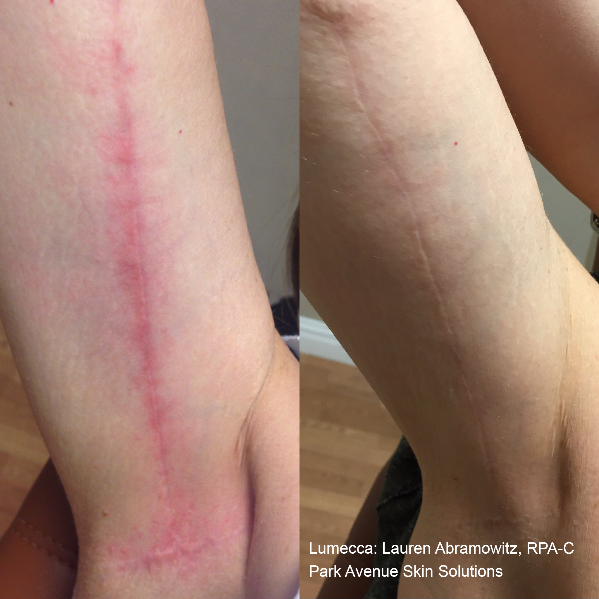 IPL treatment to minimize surgical scars redness results before and after