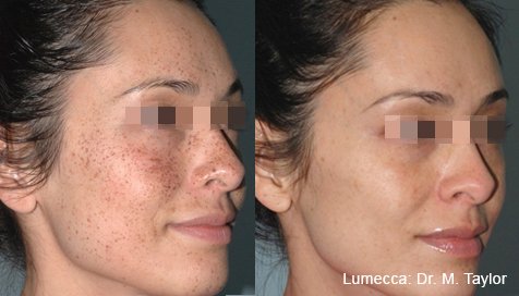 Remove freckles sun damage with IPL Photofacial before and after