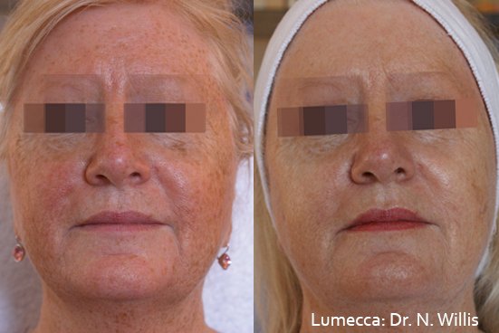 Reduce sun damage before and after with IPL Photofacial Lumecca