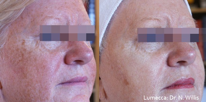 Before and after Lumecca IPL Photofacial