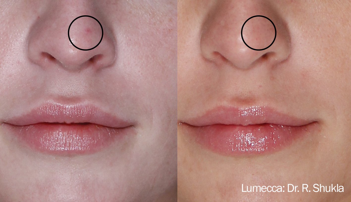 Reduce red spots and face cheek discoloration with IPL Photofacial