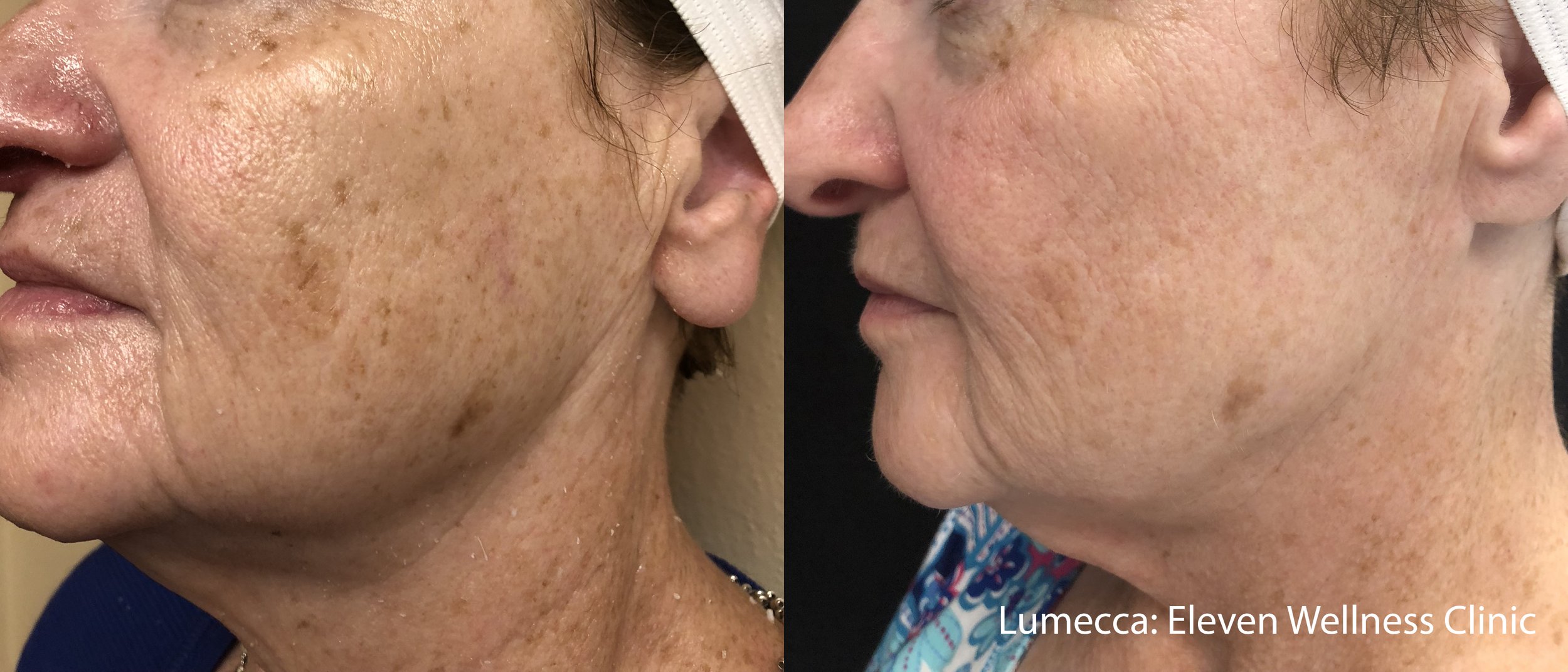 IPL treatment results before and after remove age spots