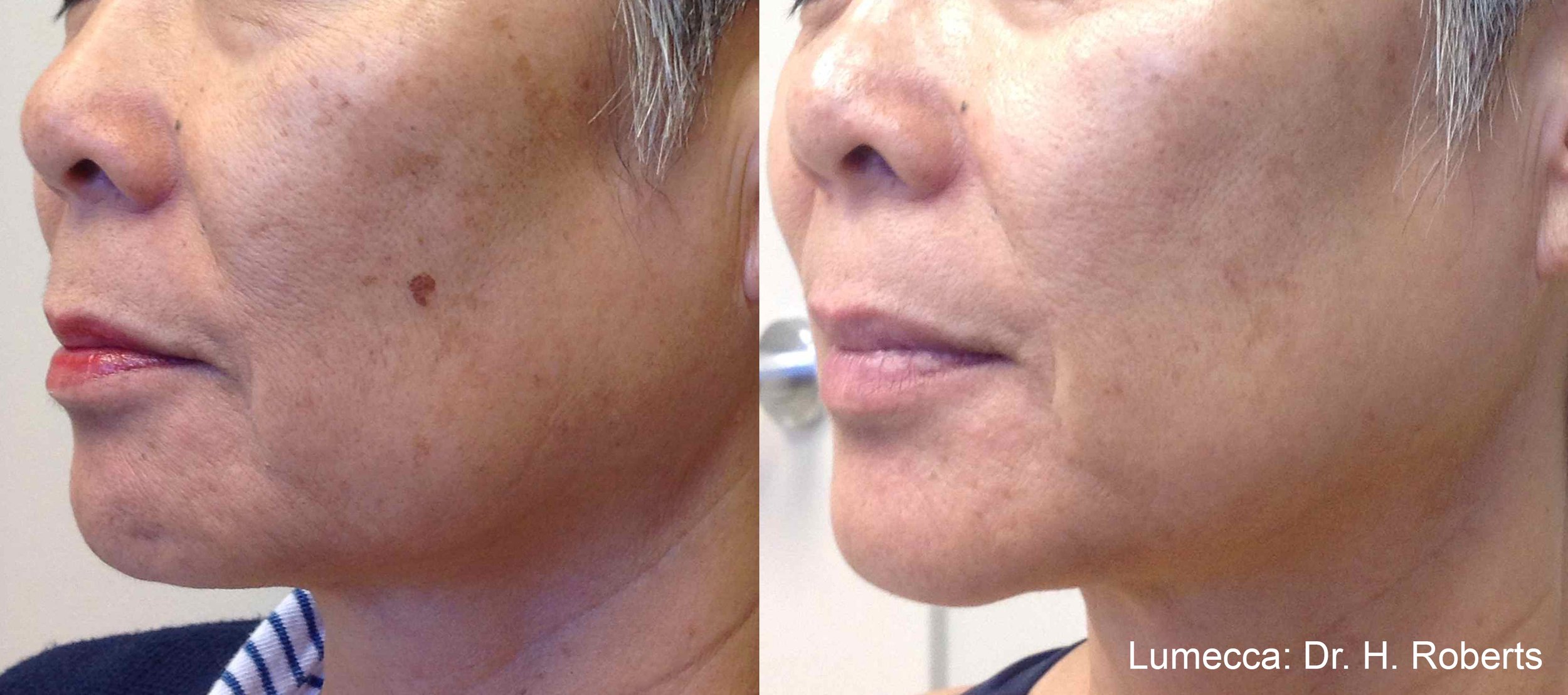 IPL before and after results age spots on cheek