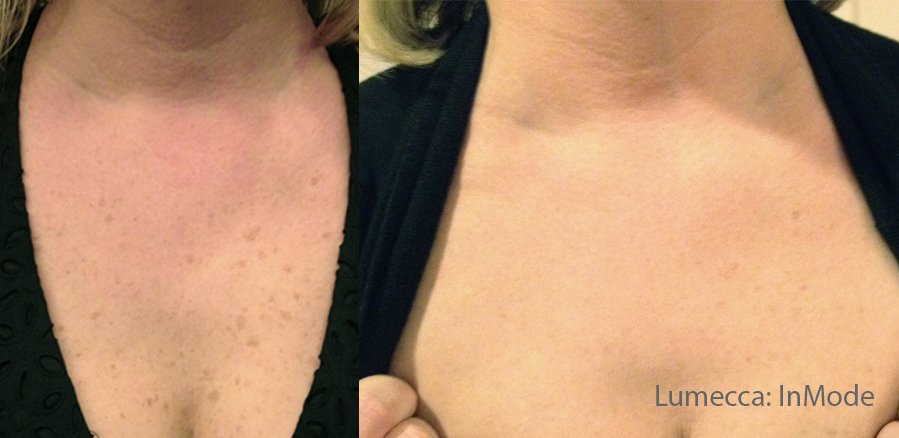 IPL Photofacial with Lumecca treatment before and after freckles on skin dark spots