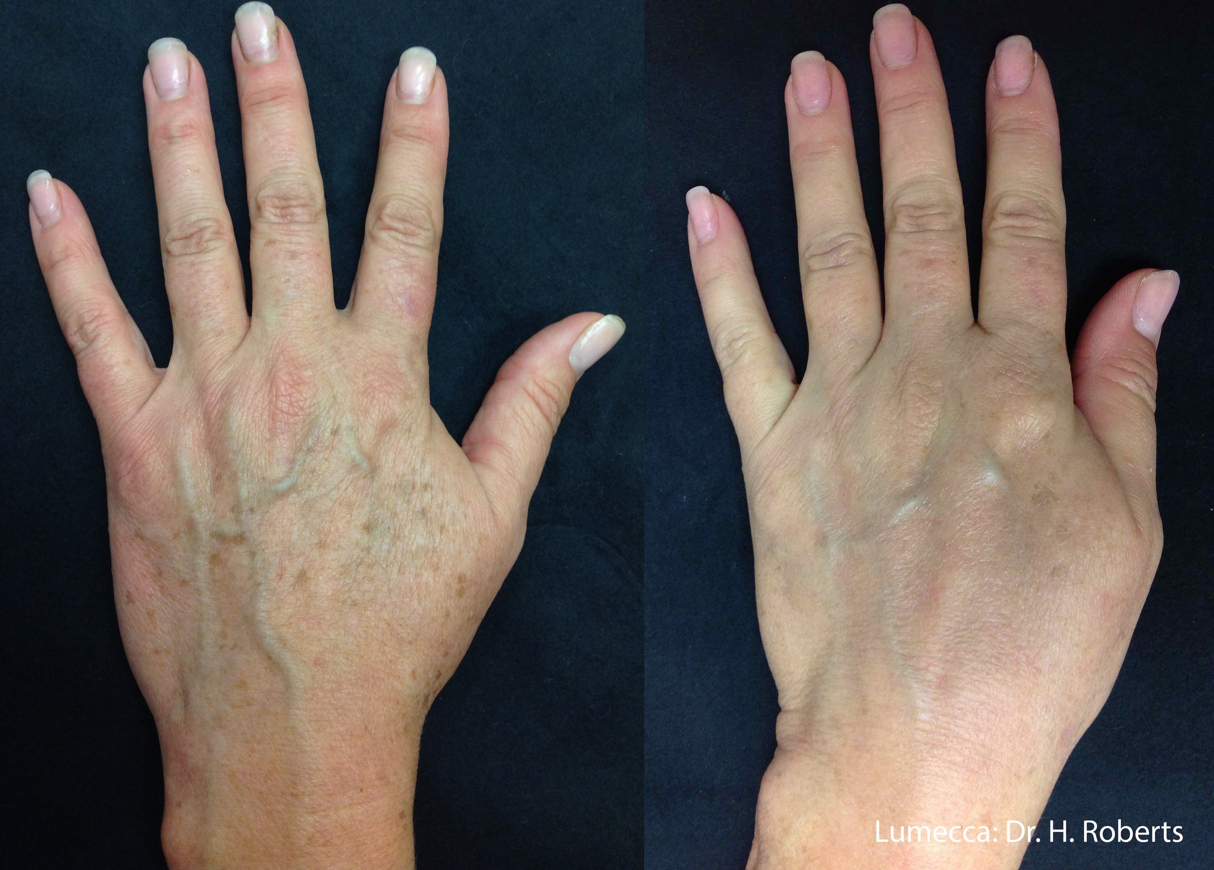 Remove sun damage on hands with IPL Lumecca before and after
