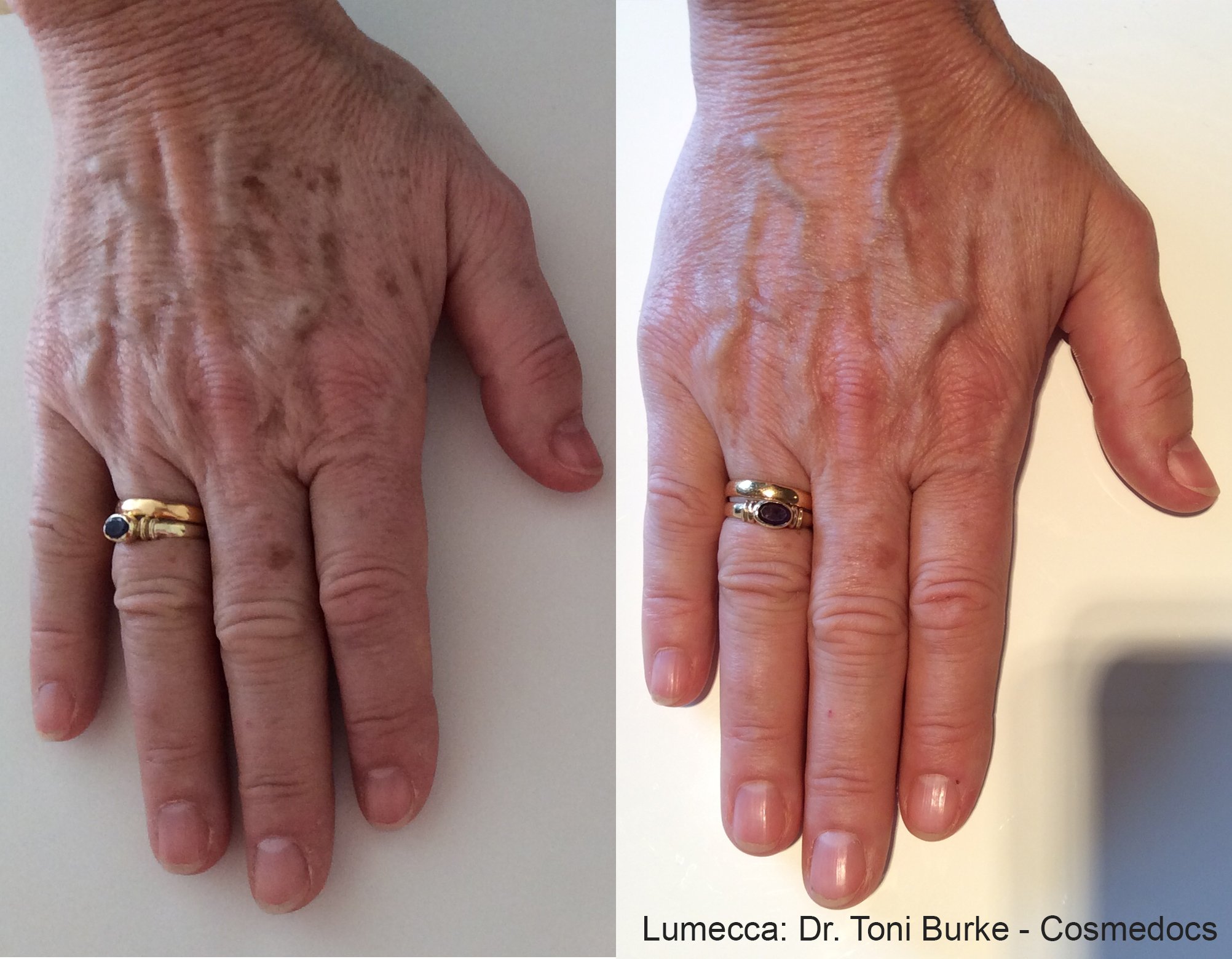 Remove age spots on hands with IPL Photofacial by Lumecca