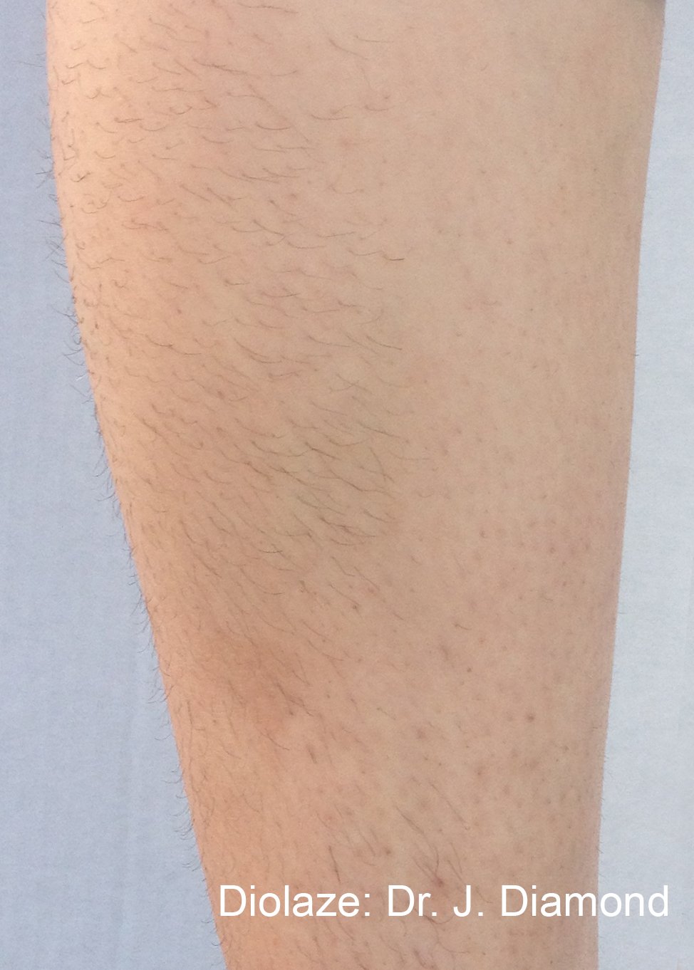 Laser hair removal results fair skin