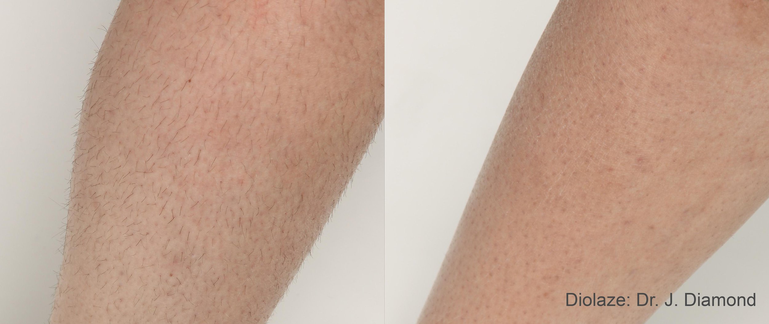 Diolaze XL Laser Hair Removal before and after