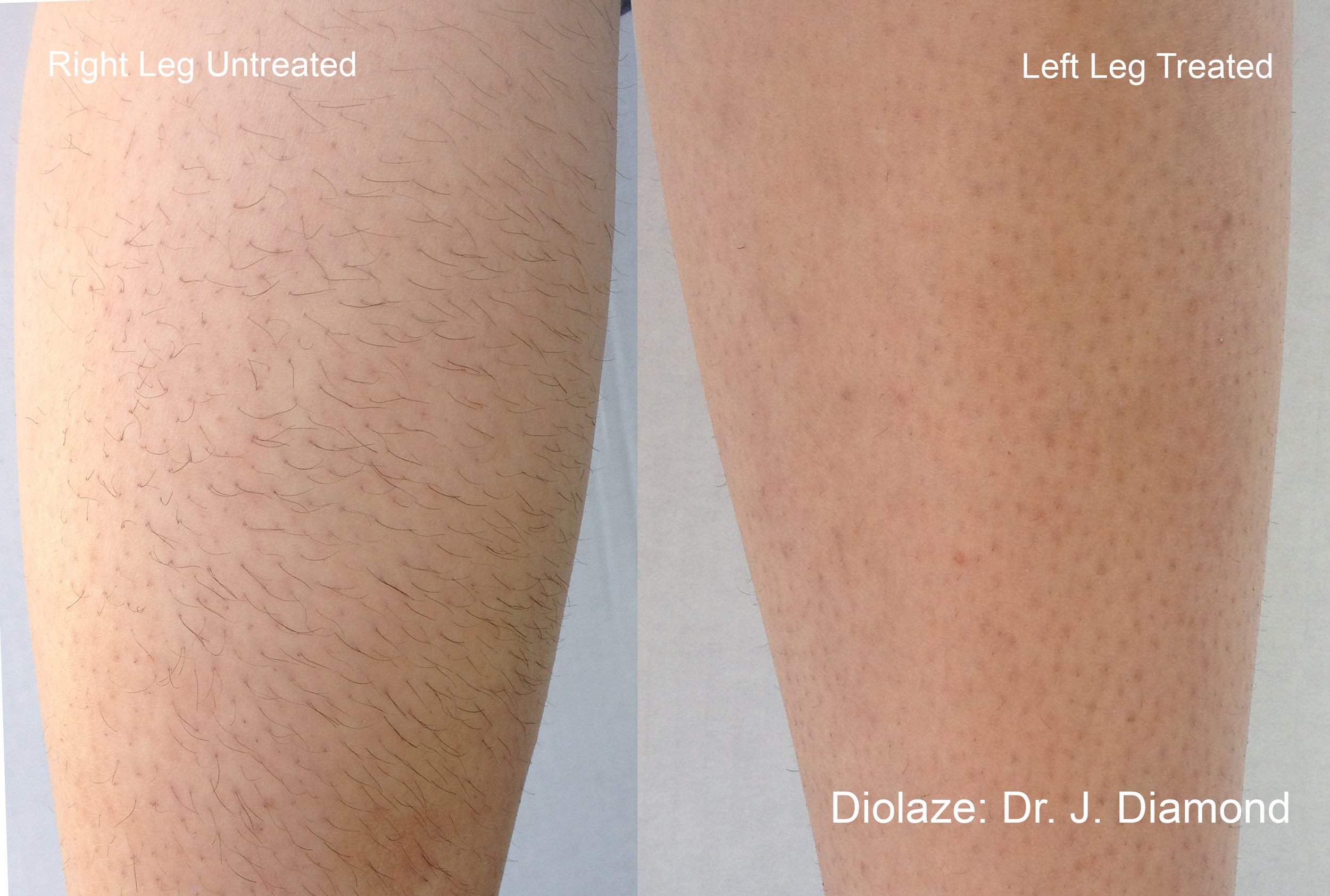 Laser hair removal before and after light skin legs