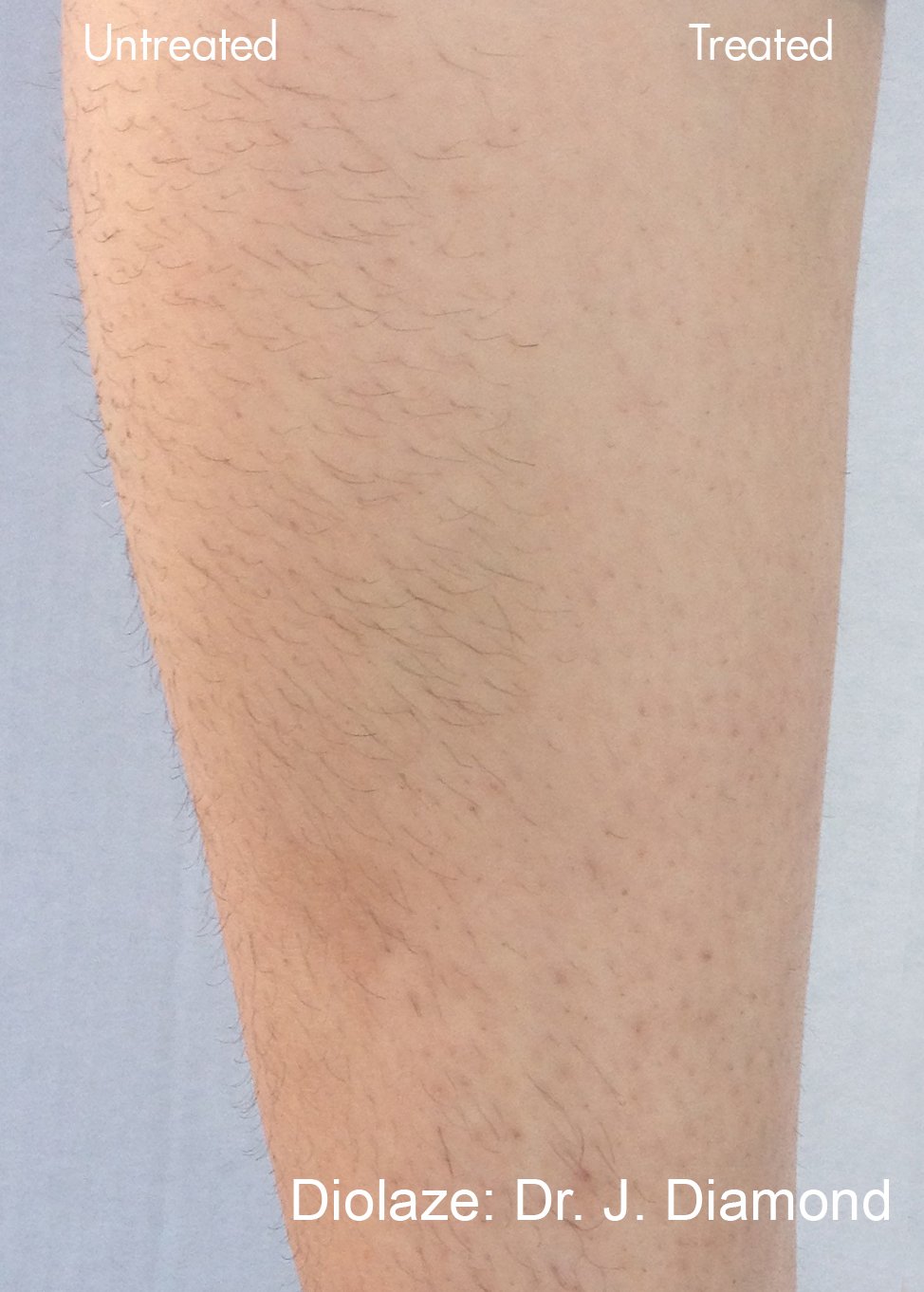 Laser hair removal results before and after