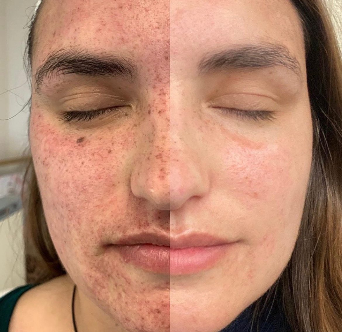 IPL Photofacial results before and after renew skin