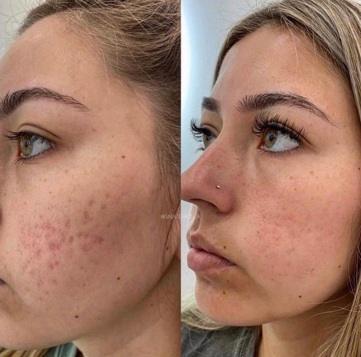 Reduce acne scars before and after with IPL Photofacial