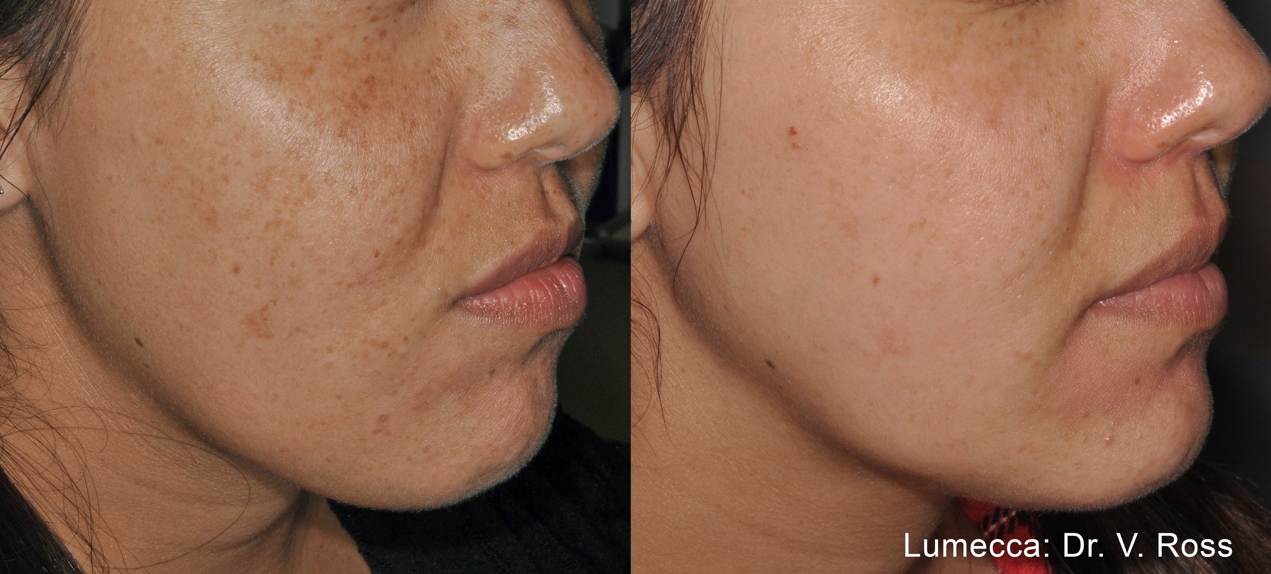 Before and after IPL Photofacial with Lumecca cheeks face