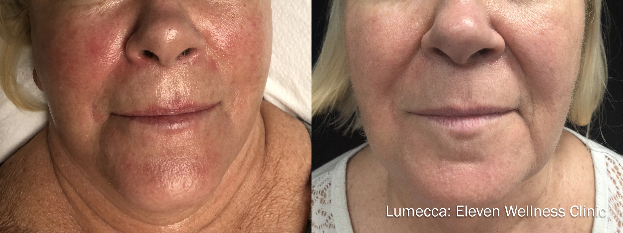 IPL Photofacial before and after results with Lumecca