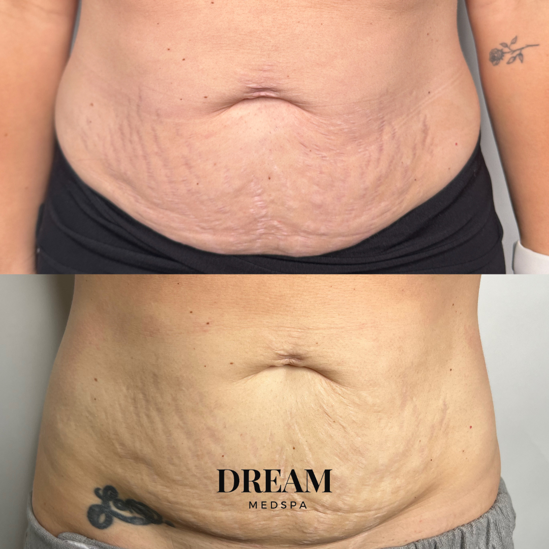 Morpheus8 Body Abdomen Before and After