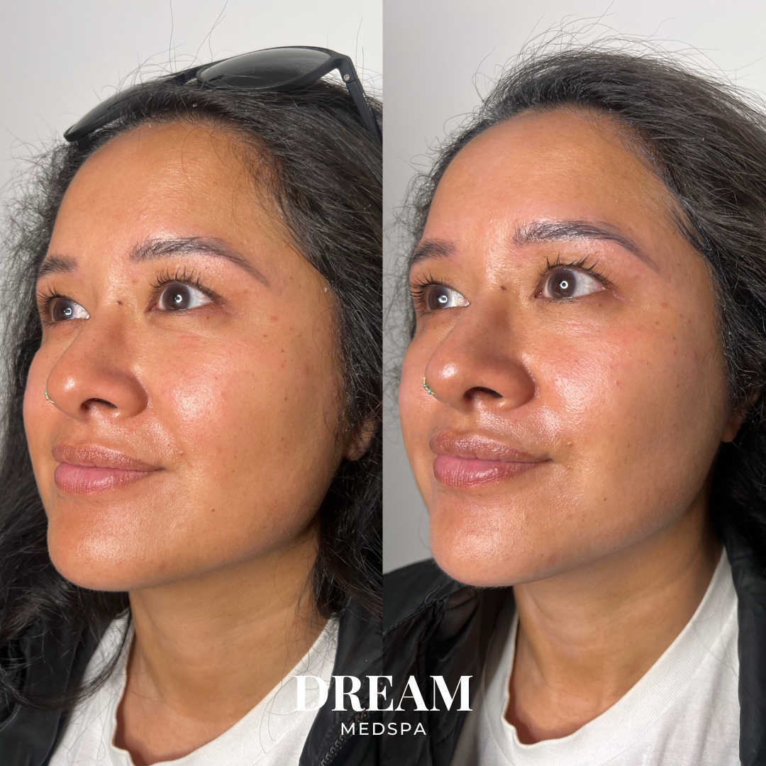 A side-by-side comparison of a woman’s face before and after a skincare treatment, showing improved skin texture and glow. The woman has dark hair, a nose ring, and is wearing sunglasses on her head in the first image. The background is a plain, ligh