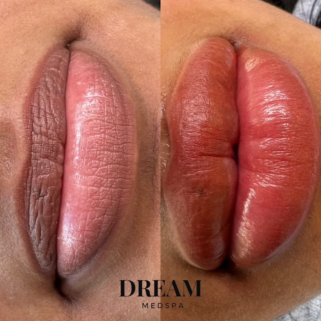 Close-up comparison of lips before and after a cosmetic lip treatment, showing plumper and more defined lips on the right.
