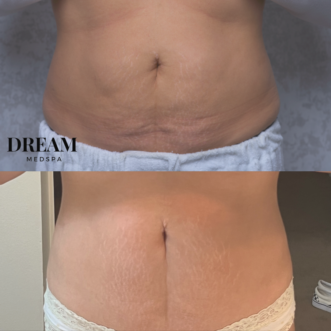 Morpheus8 Body Abdomen Results