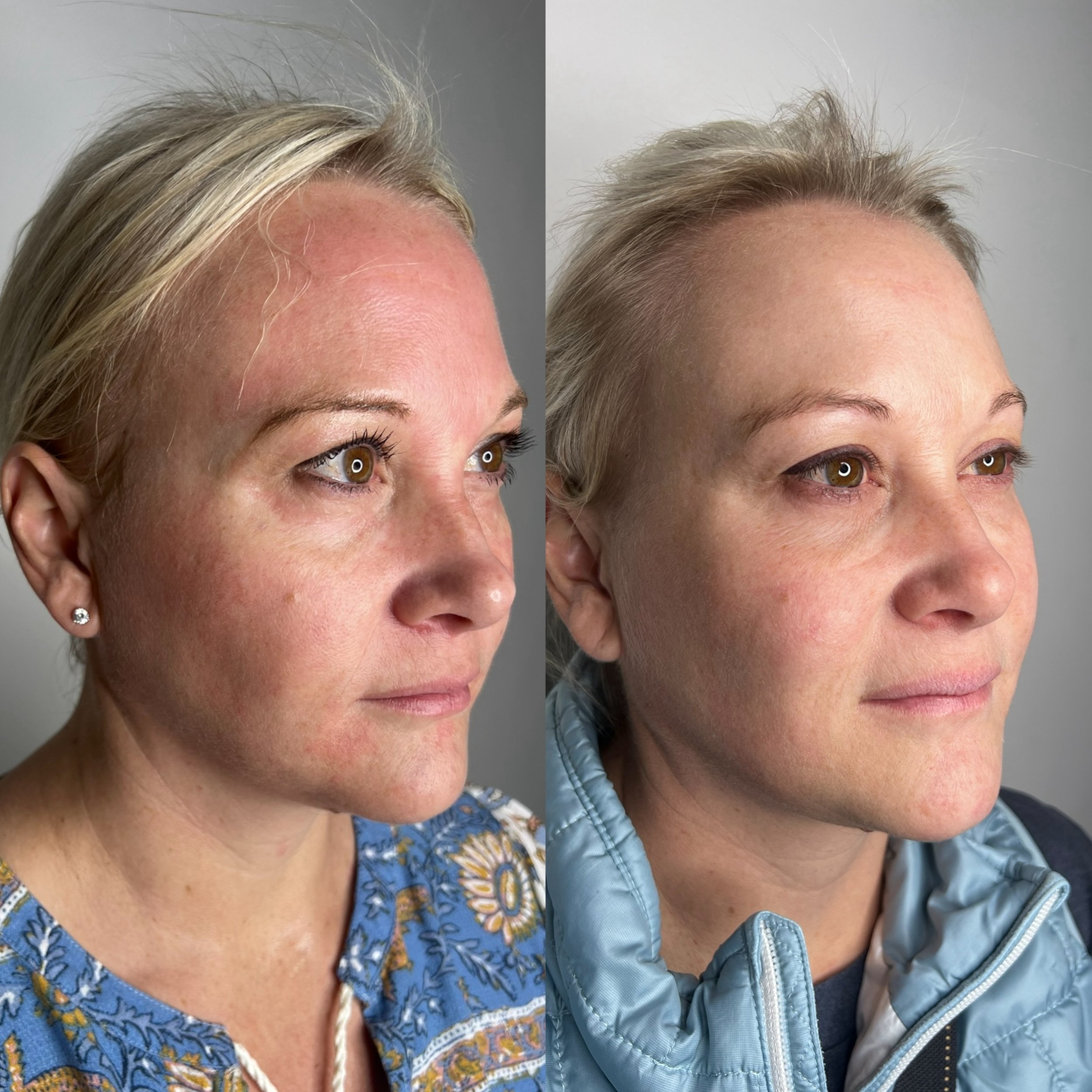 Address your skin concerns and irregularities with #morpheus8 + #ipl customizable fractional treatments🔥😌

Patients before and after, after just 1 treatment of ipl and morpheus8!!

-
-
-
_____________________________

👩🏻&zwj;⚕️Erica Roybal
(@eric