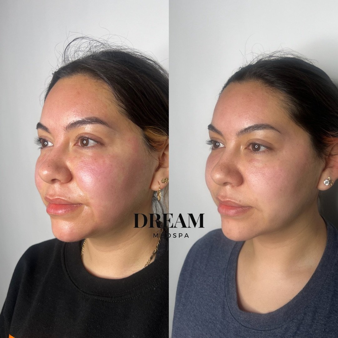 Side-by-side photos of a woman before and after skincare treatment, showing improved skin texture and reduced redness at Dream Medspa.