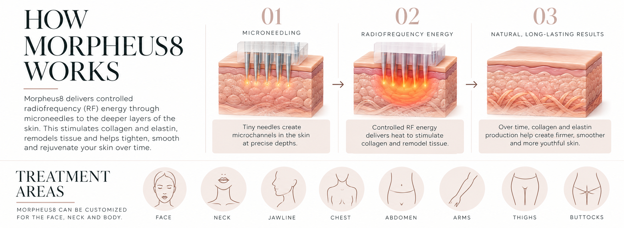 Morpheus8 treatment guide infographic