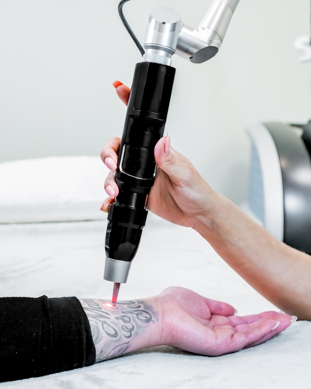 Is Laser Tattoo Removal Worth It?
