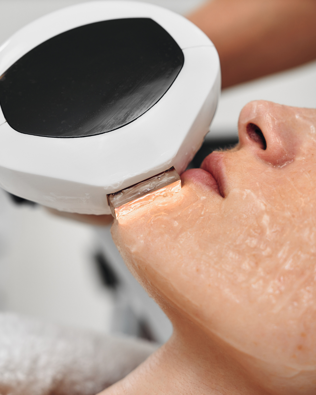 IPL Photofacial for Sun Damage in Denver: What You Should Know
