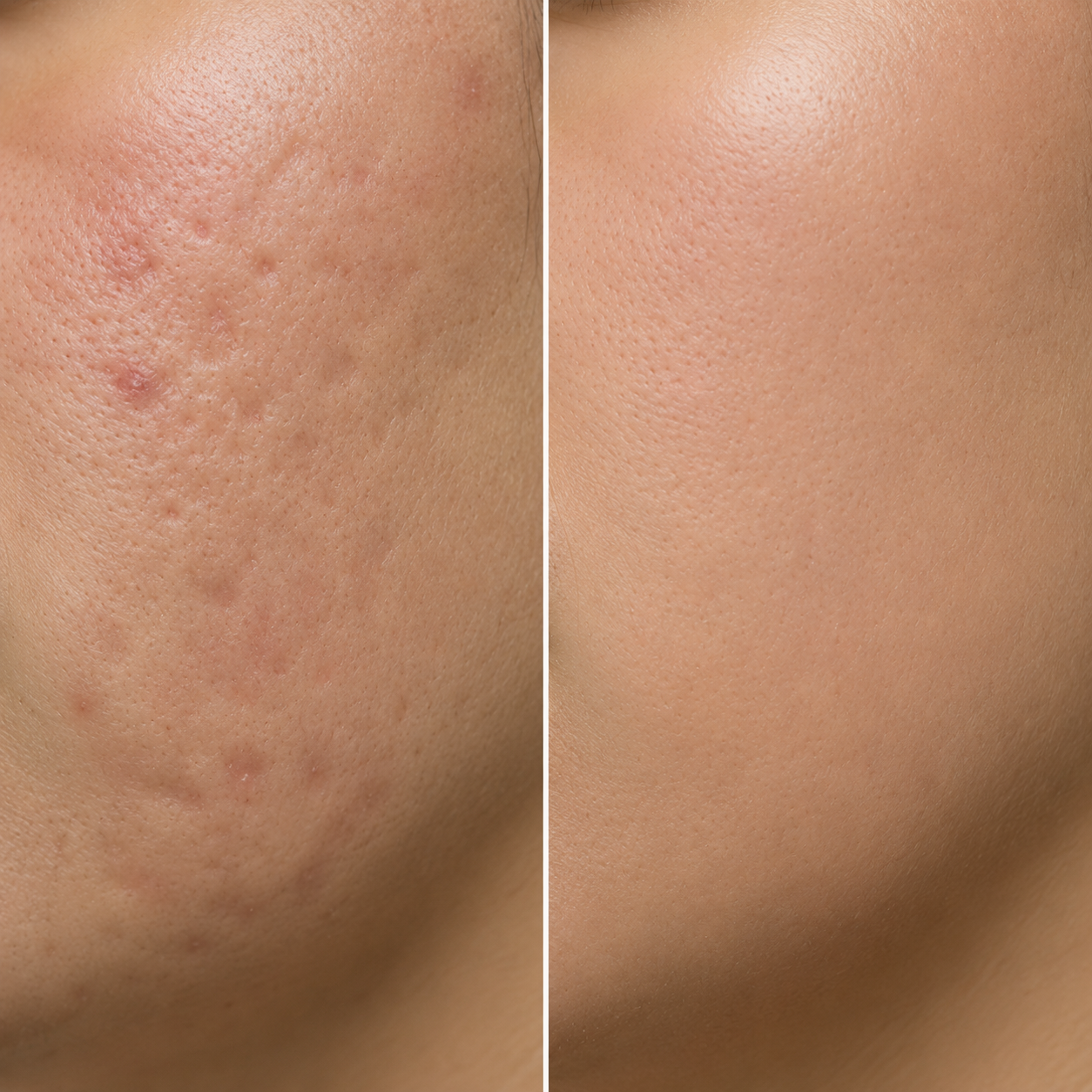 acne laser facial before and after.png