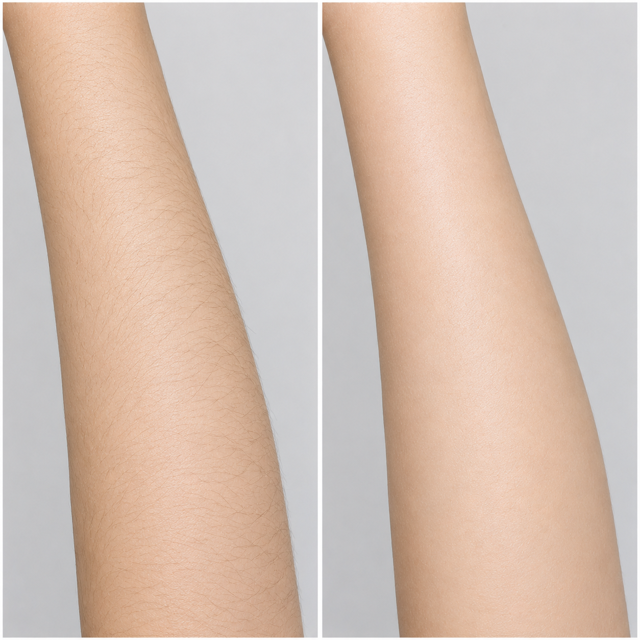 before and after arm hair laser hair removal.png
