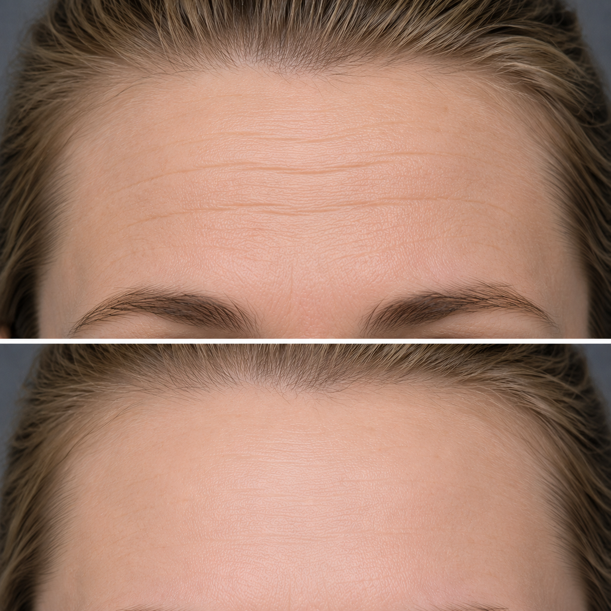before and after neurotoxins dream medspa.png
