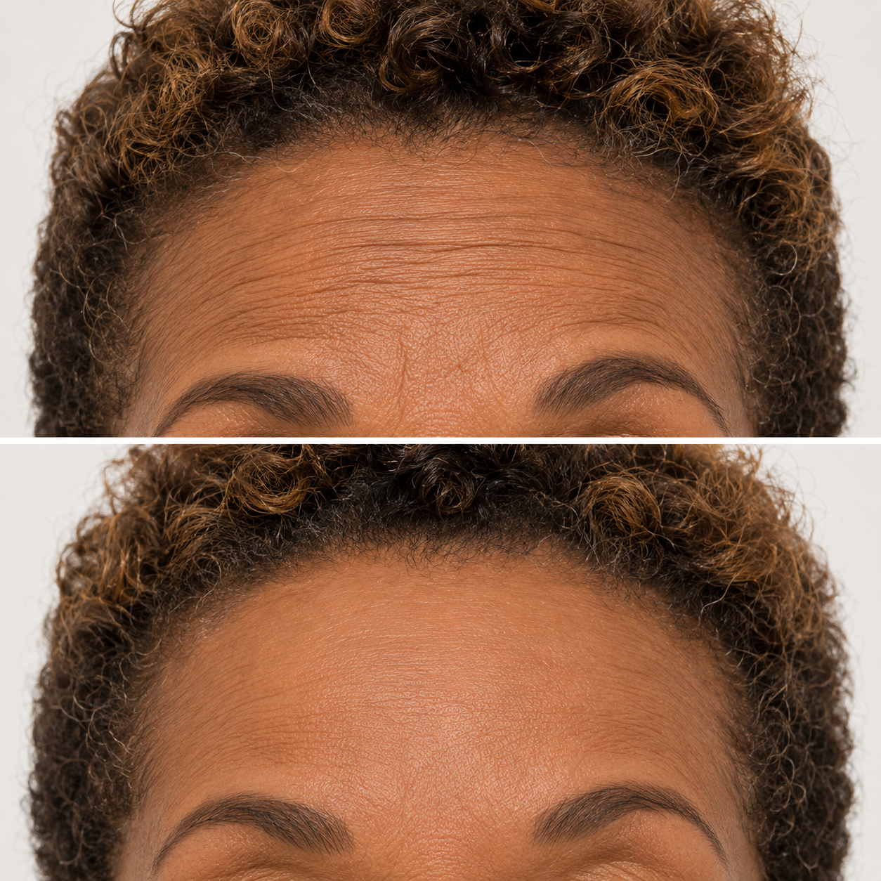 before and after neurotoxins fitz 6 denver.png