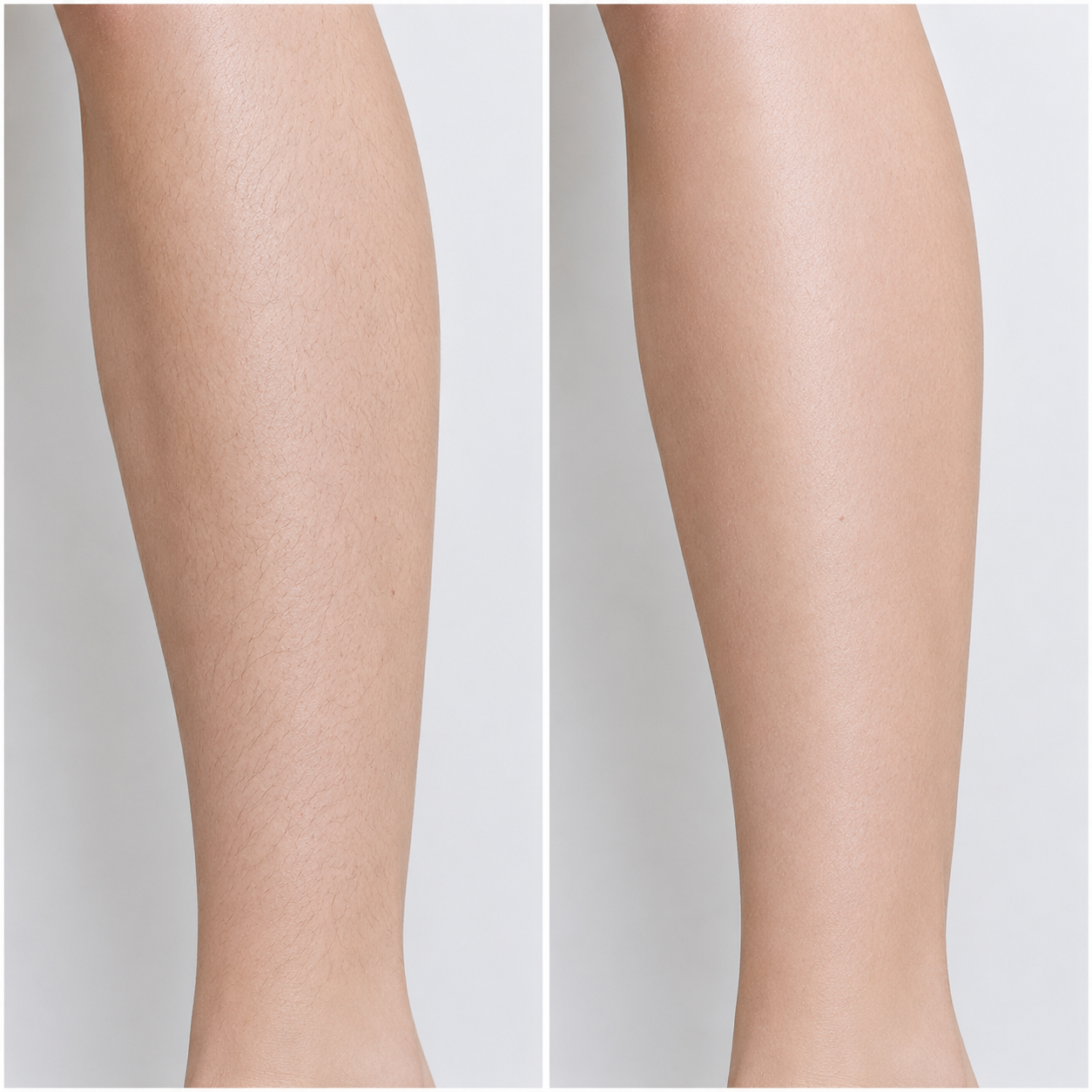 before and after laser hair removal legs.png