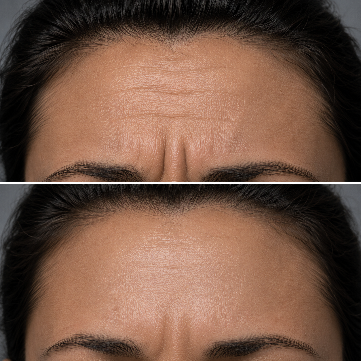 before and after tox at denver dream medspa.png