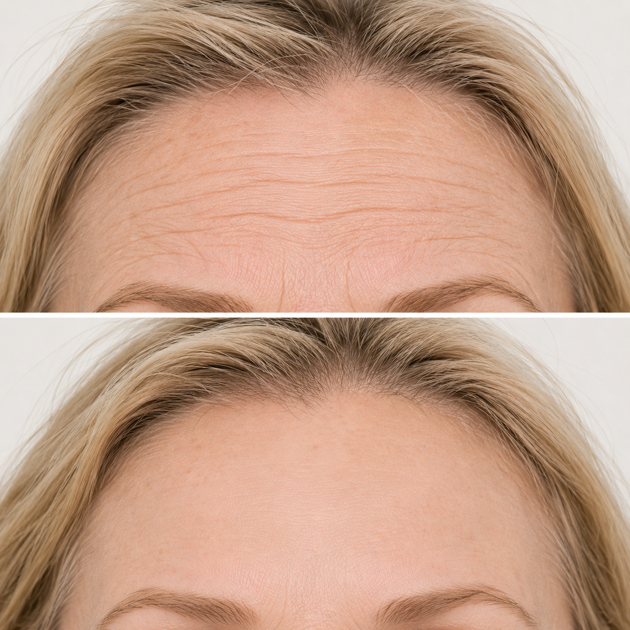 before and after neurotoxins fitz 1 mature denver.png