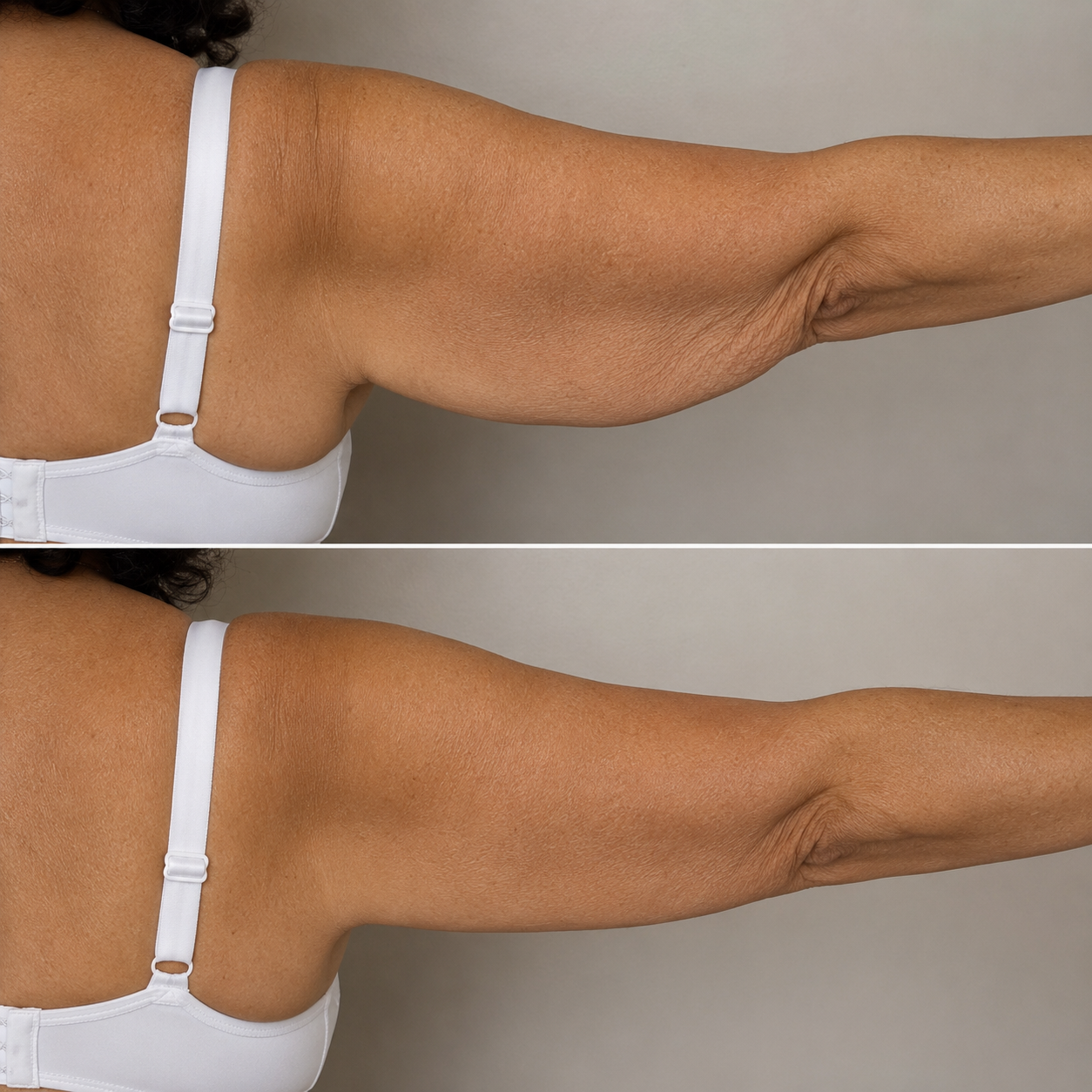 before and after morpheus8 arm laxity denver dream medspa.png