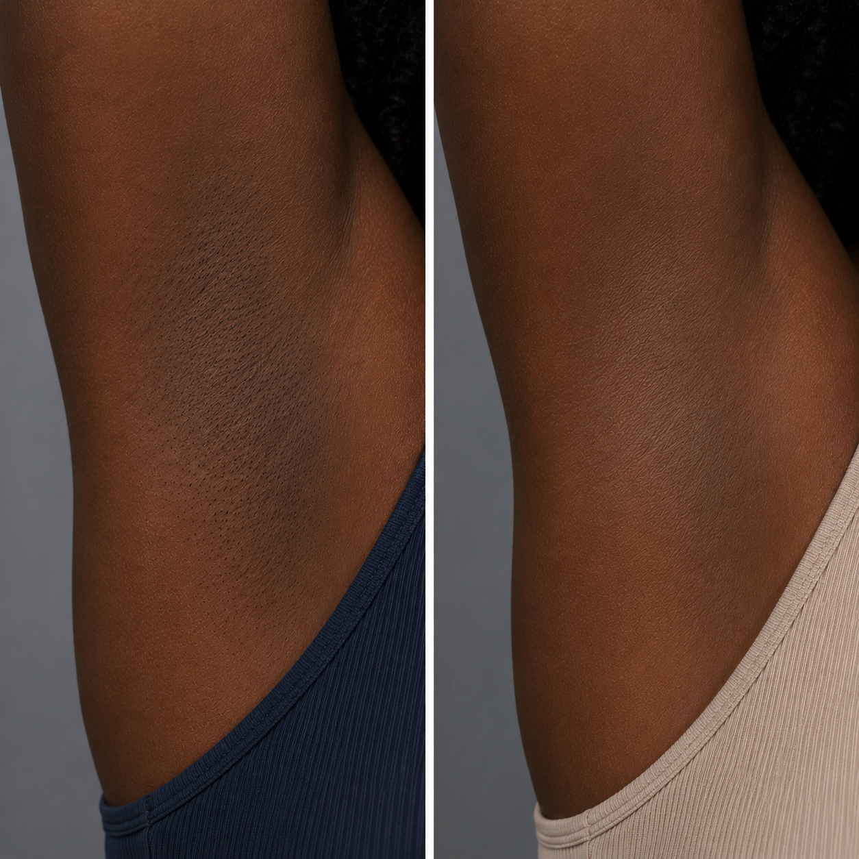 before and after darker underarms laser hair removal.png