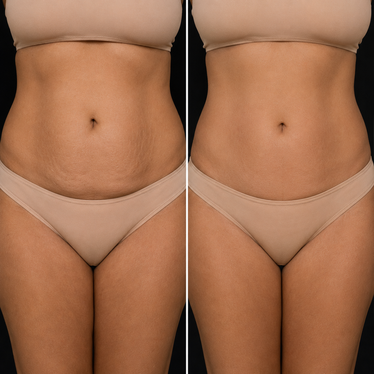 before and after morpheus8 body contouring denver.png