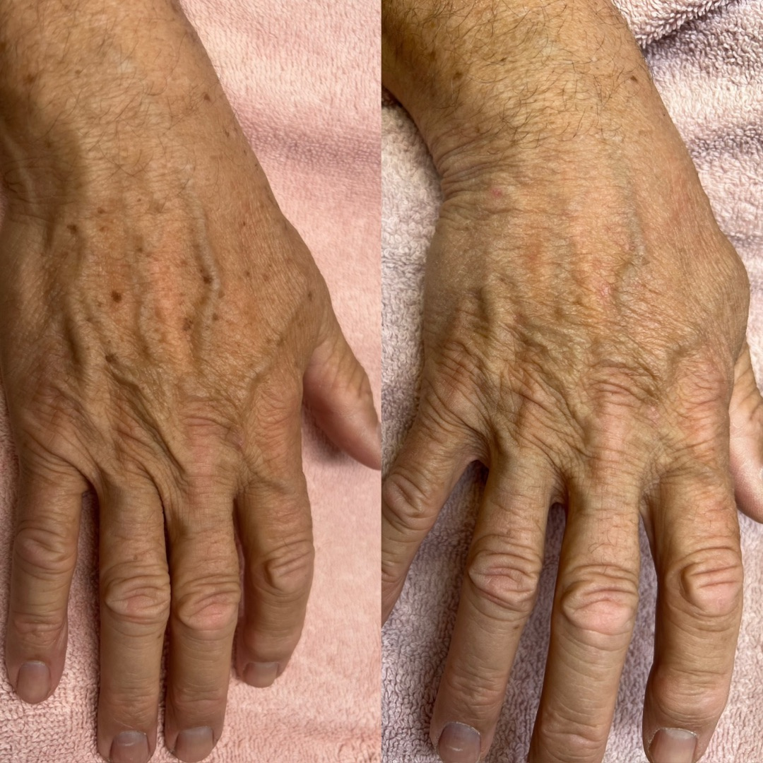 Brown spot reduction in before and after from IPL photofacial treatment