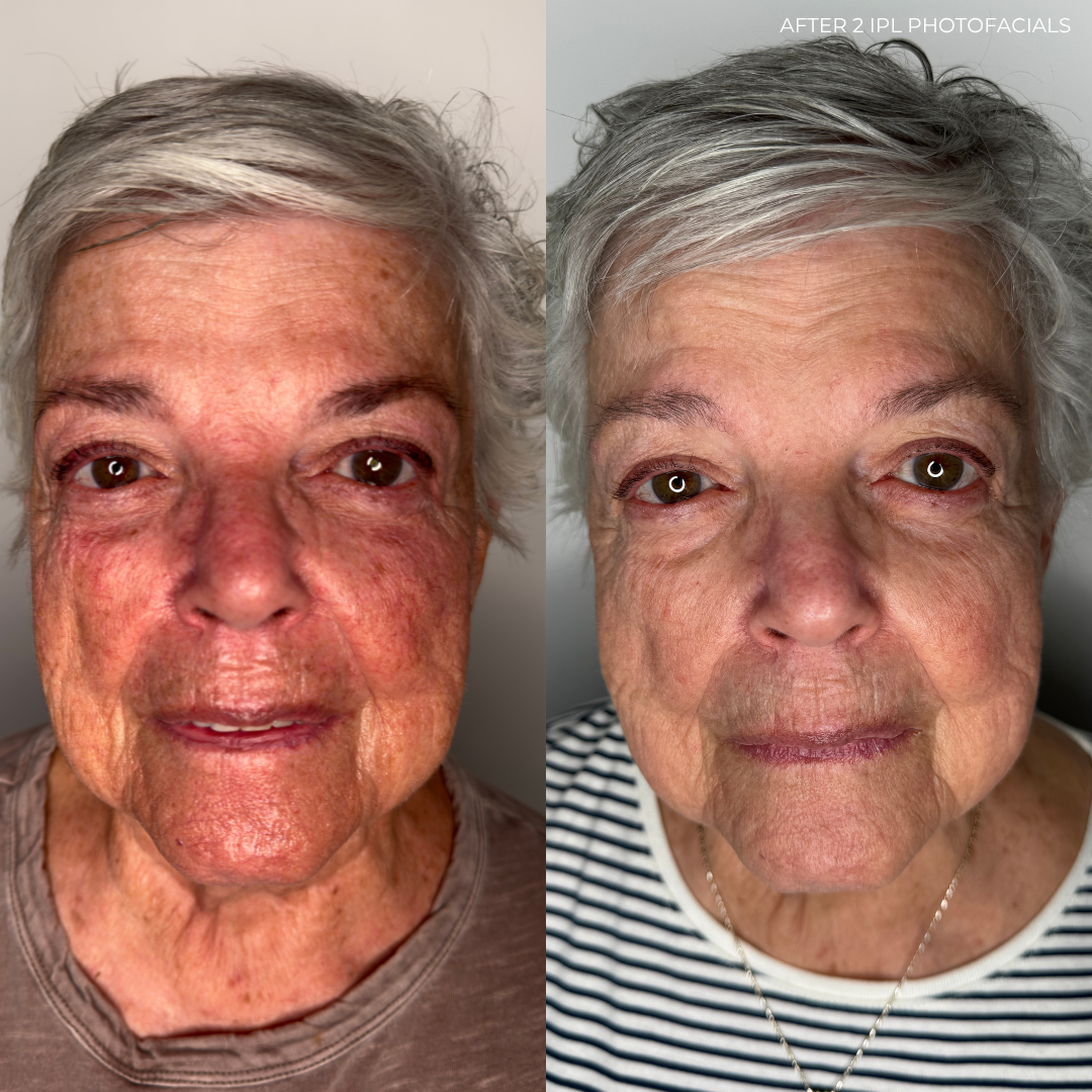 Side-by-side comparison of a woman's face before and after two IPL photofacial treatments, showing reduced redness, pigmentation, and improved skin texture.