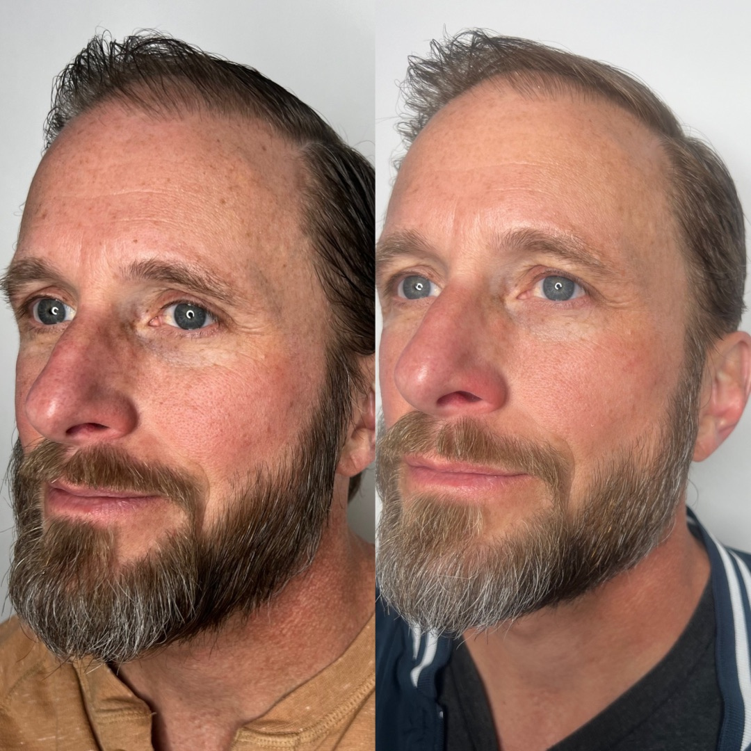 IPL Photoafacial before and after